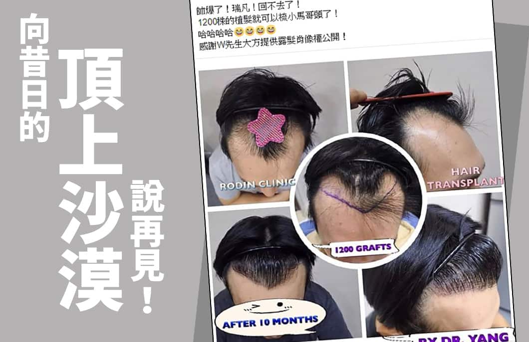 【植髮】向昔日的頂上沙漠說再見！